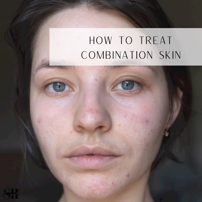 How To Treat Combination Skin