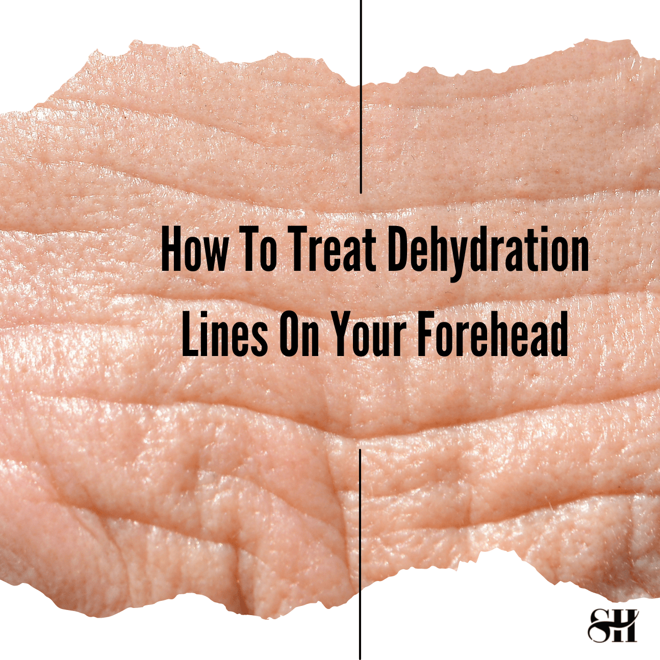 How To Treat Dehydration Lines On Forehead