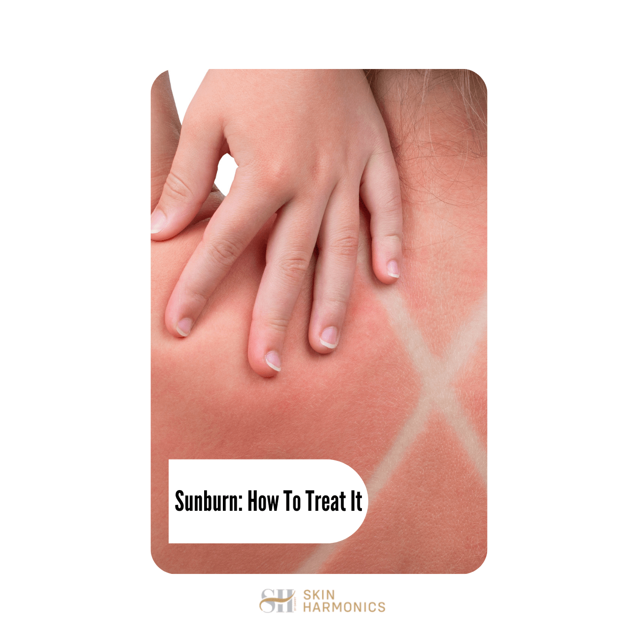 Sunburn: How To Treat It