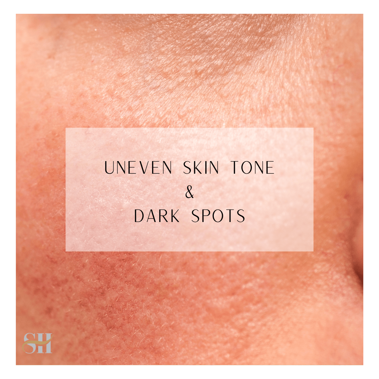 Uneven Skin Tone And Dark Spots