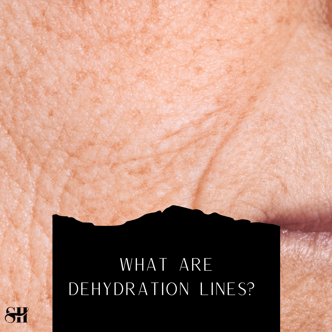 What Are Dehydration Lines?