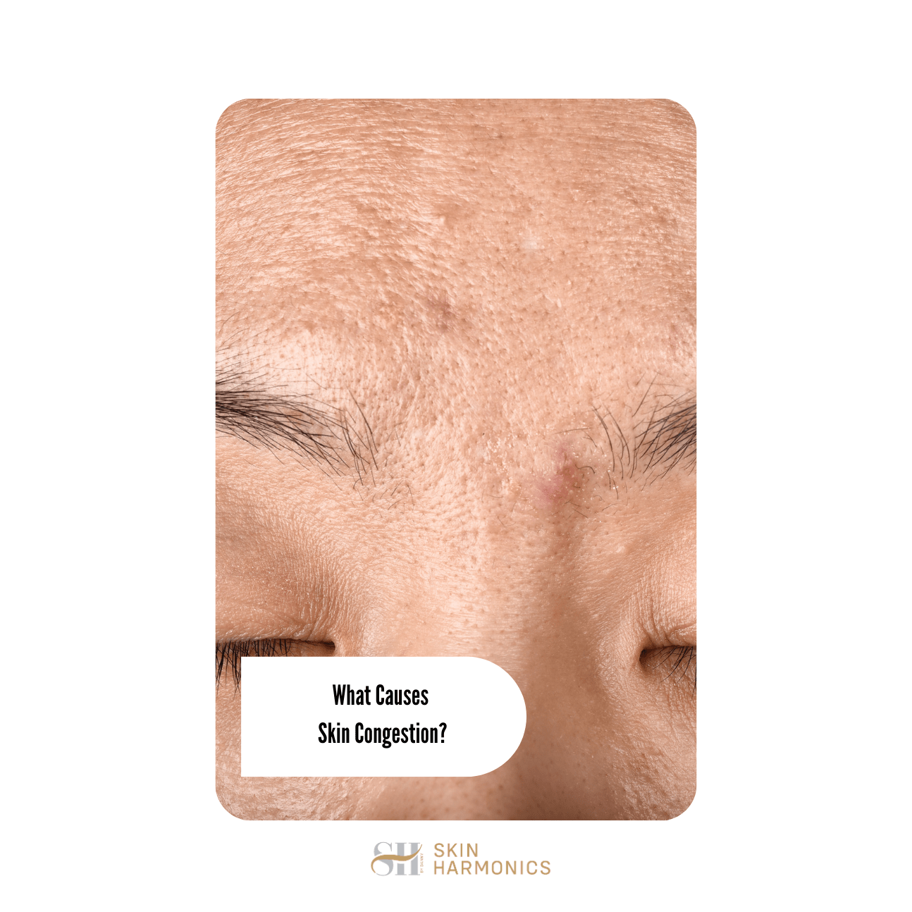 What Causes Skin Congestion?
