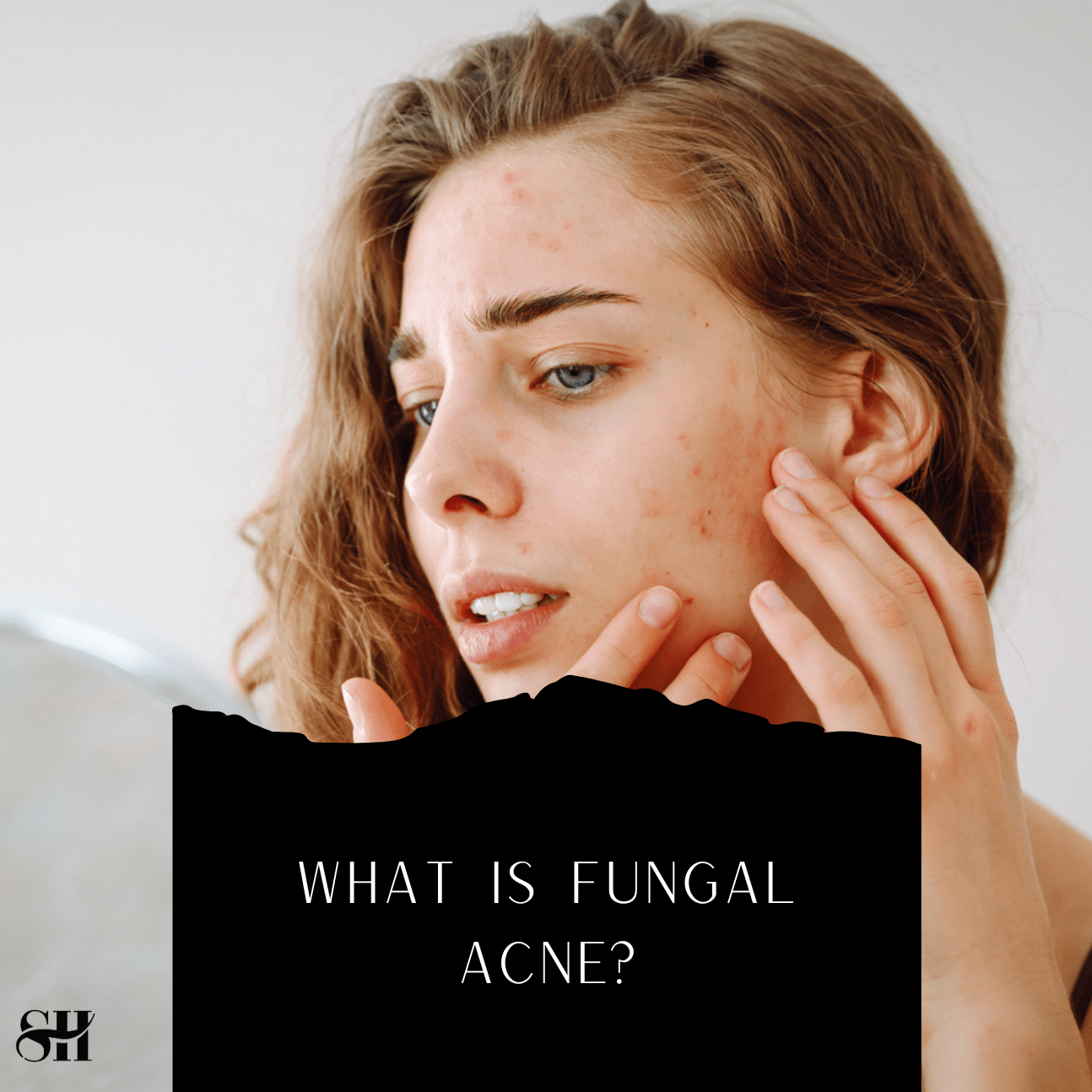 What Is Fungal Acne?