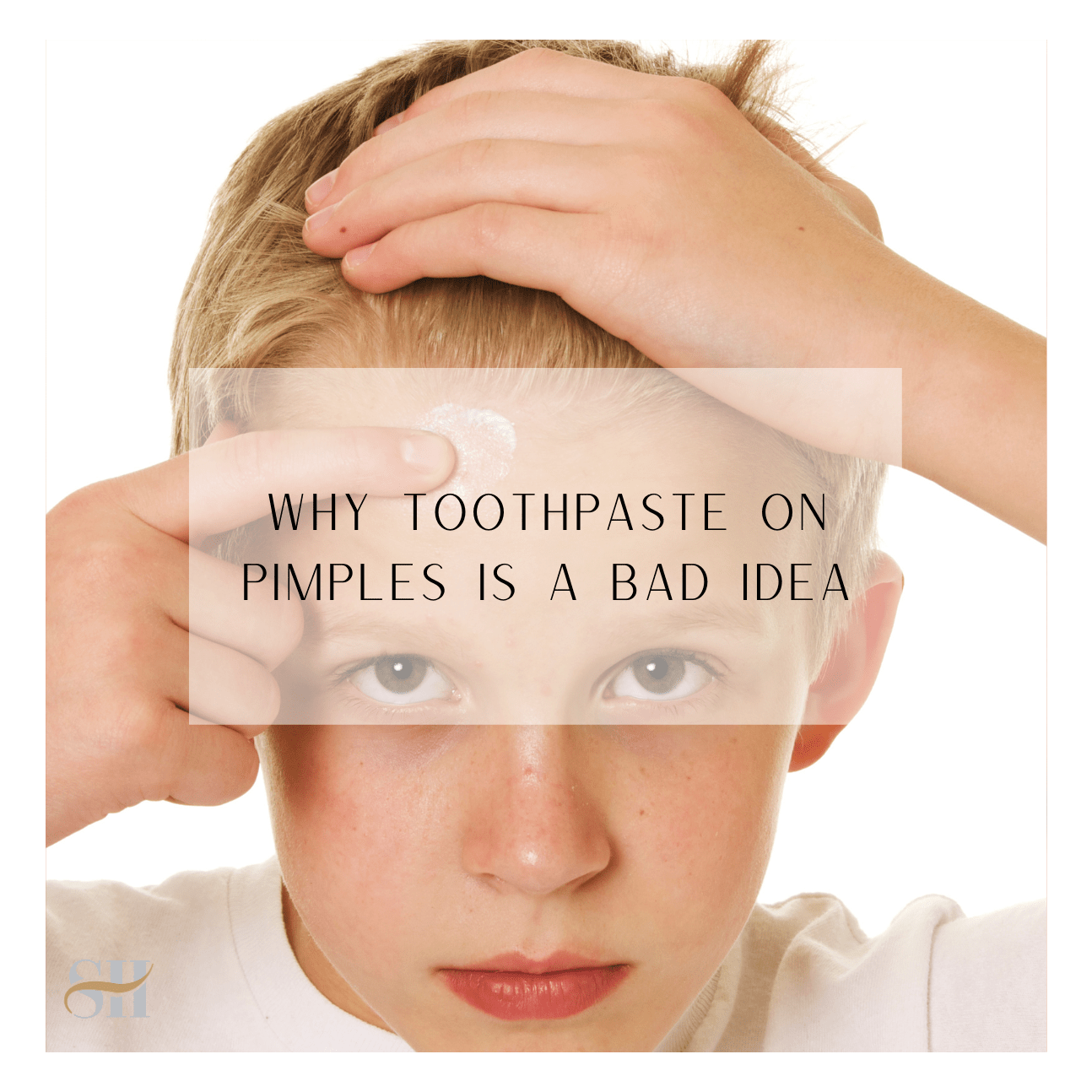 Why Toothpaste On Pimples Is A Bad Idea