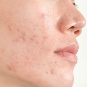 before skin Skin care clinic
