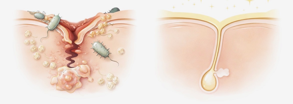 clogged pore and a clean pore